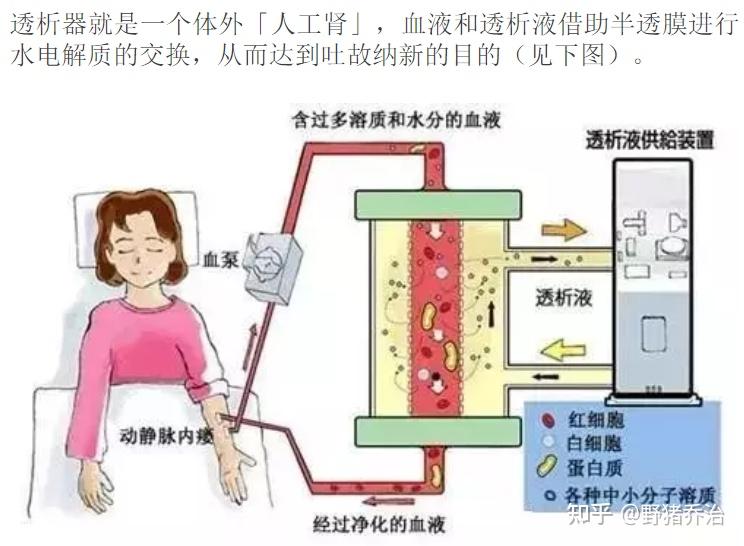 腹膜透析——利用腹膜作为生物透析膜,依赖弥散,对流,超滤作用,清除体