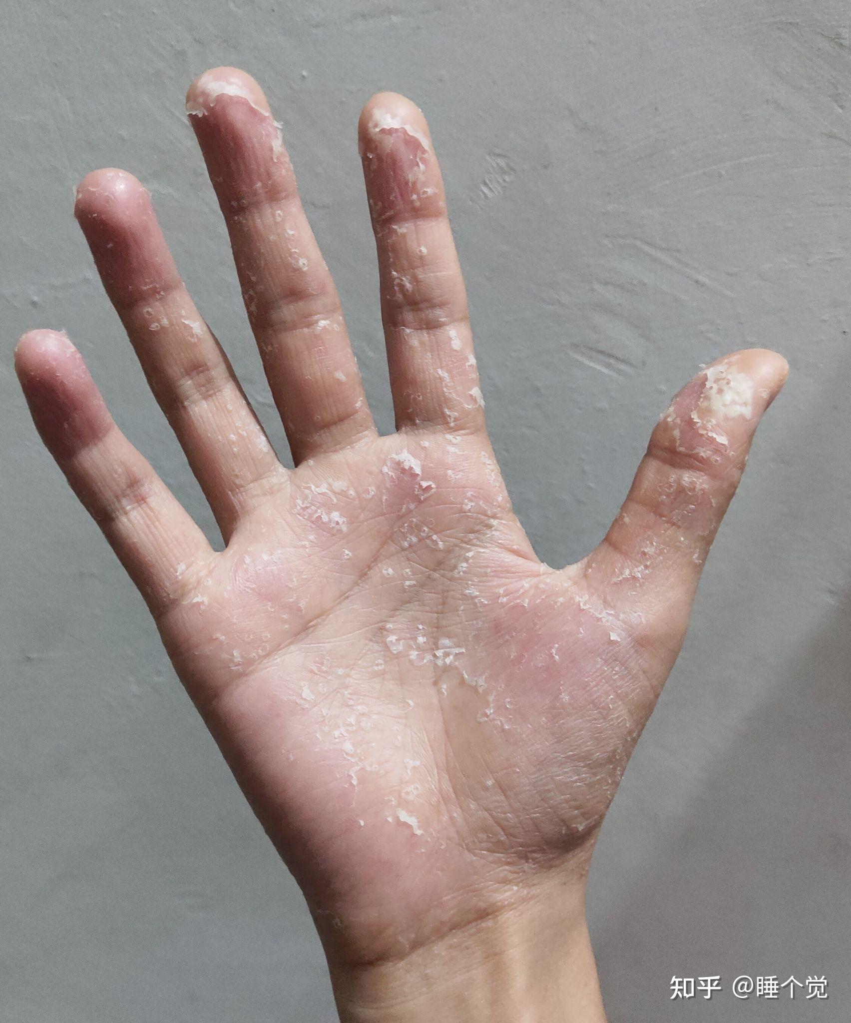 我的手汗症真的要走到动手术这一步了吗