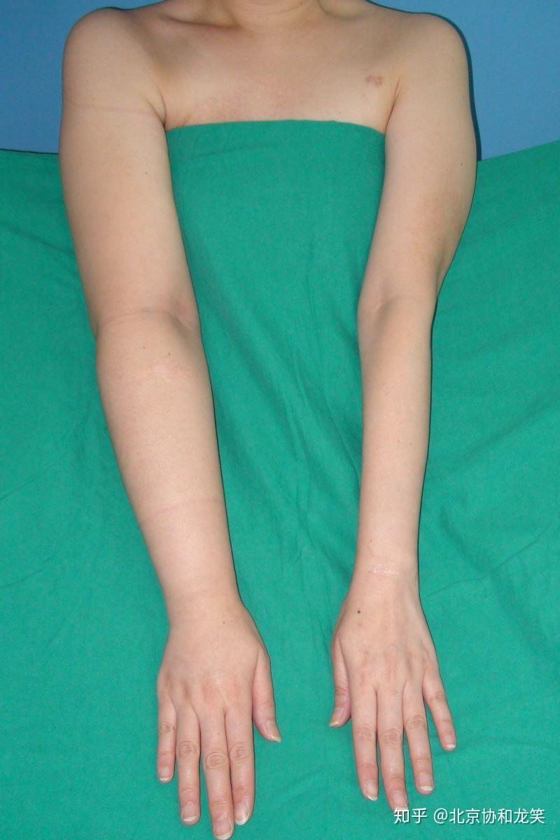 急性期淋巴水肿治疗方法是什么