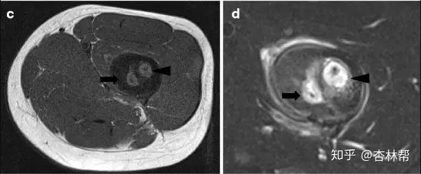 死骨的由来和转归