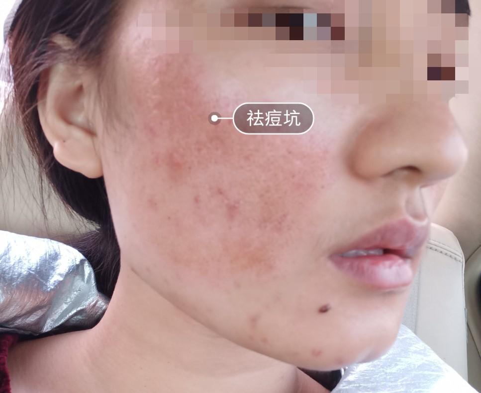 十年痘友的plasma激光去痘坑直播