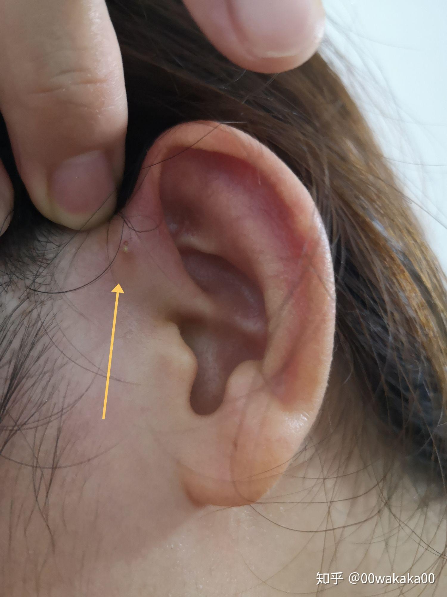 耳前瘘管遗传图谱图片