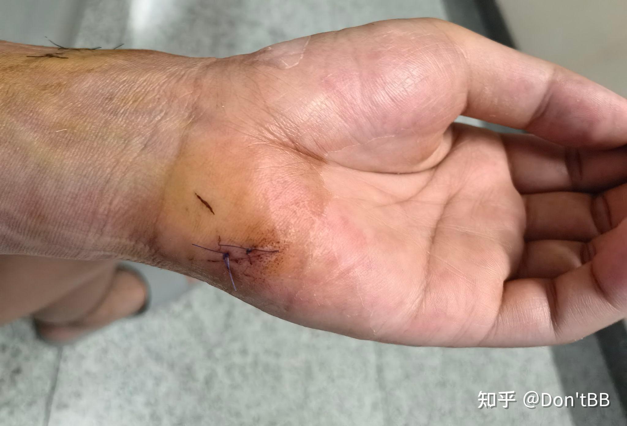 拇指肌腱断裂及恢复记录