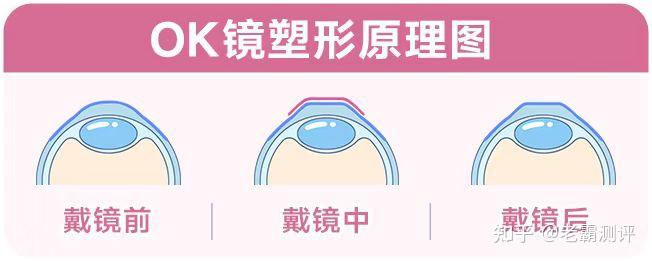 建议小朋友戴OK镜吗？理性看待OK镜的利与弊 - 知乎
