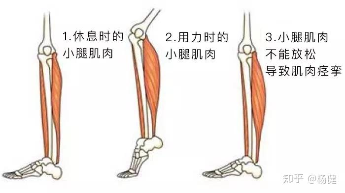 小腿抽筋真的是身体缺钙吗