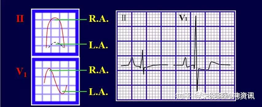 p波異常心電圖口訣
