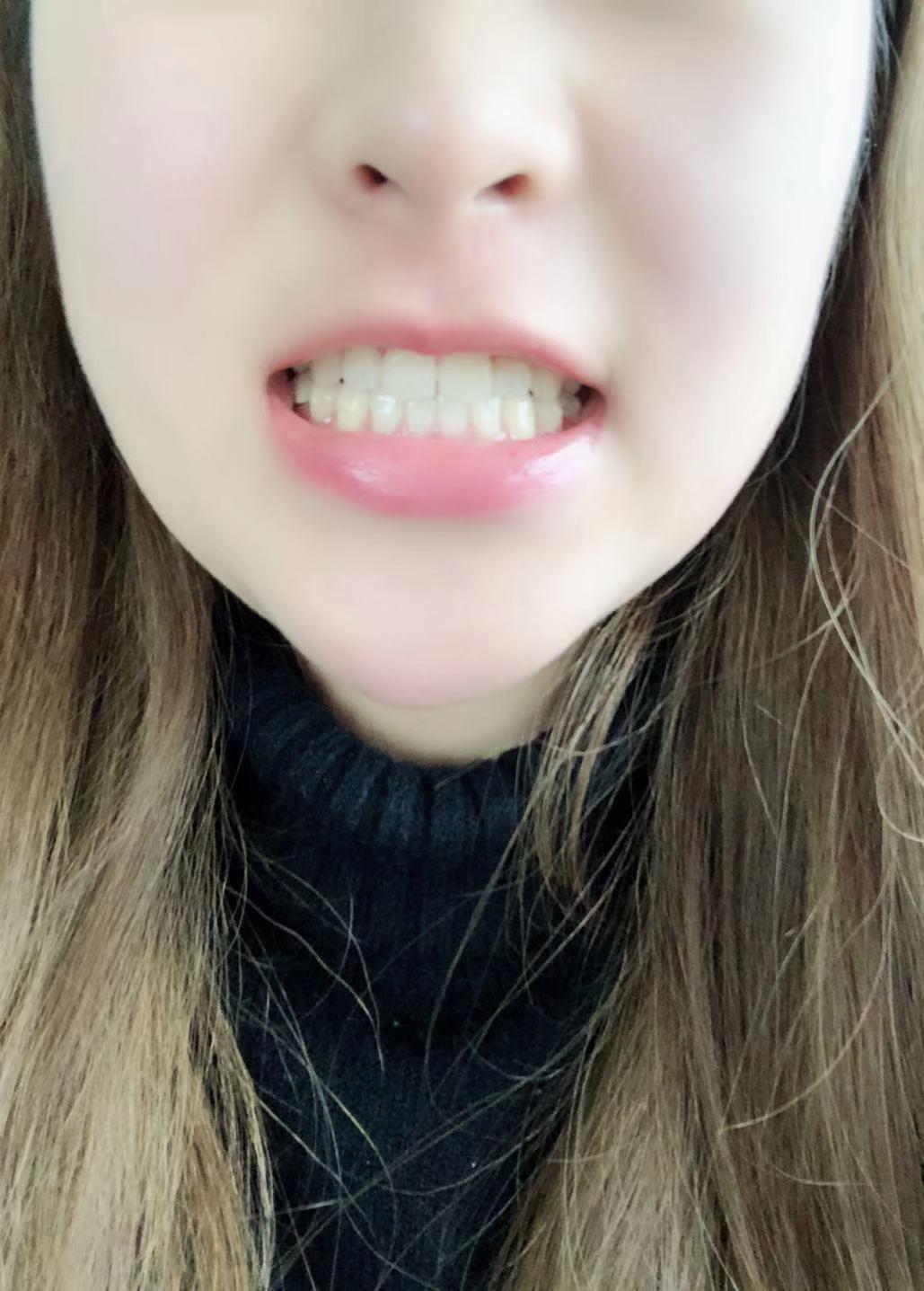 360美牙拯救我的大牙缝,给大家分享我的矫正成果 - 知乎