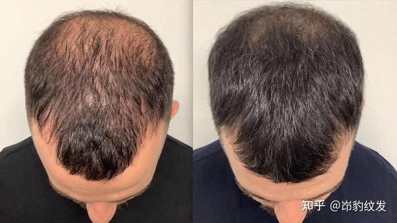 头发纹身 脱发替代品
