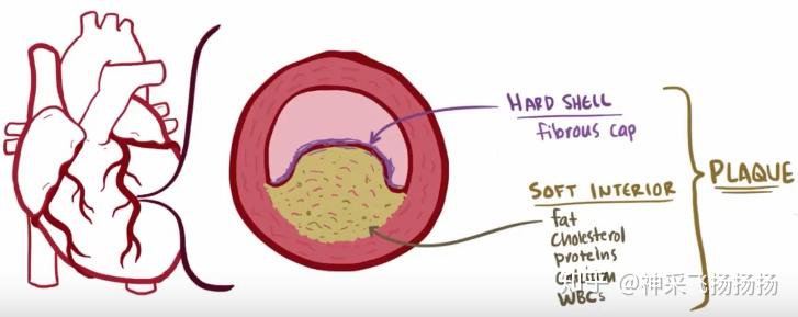 医学科普之心脏病发作急性心肌梗死acutemyocardialinfarction
