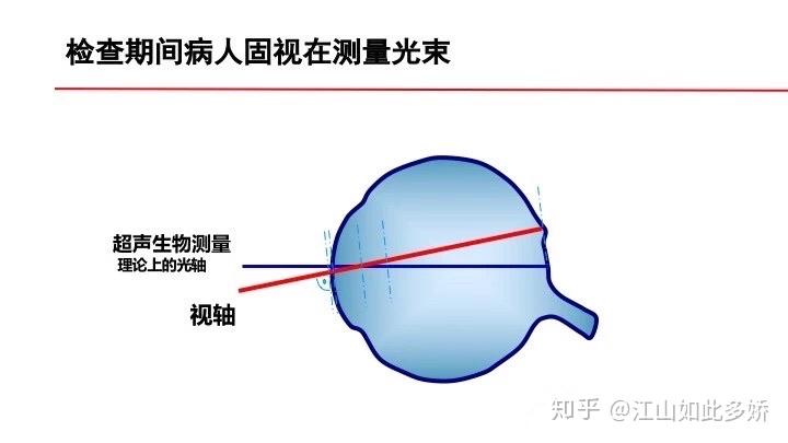 眼视光眼轴长度解析