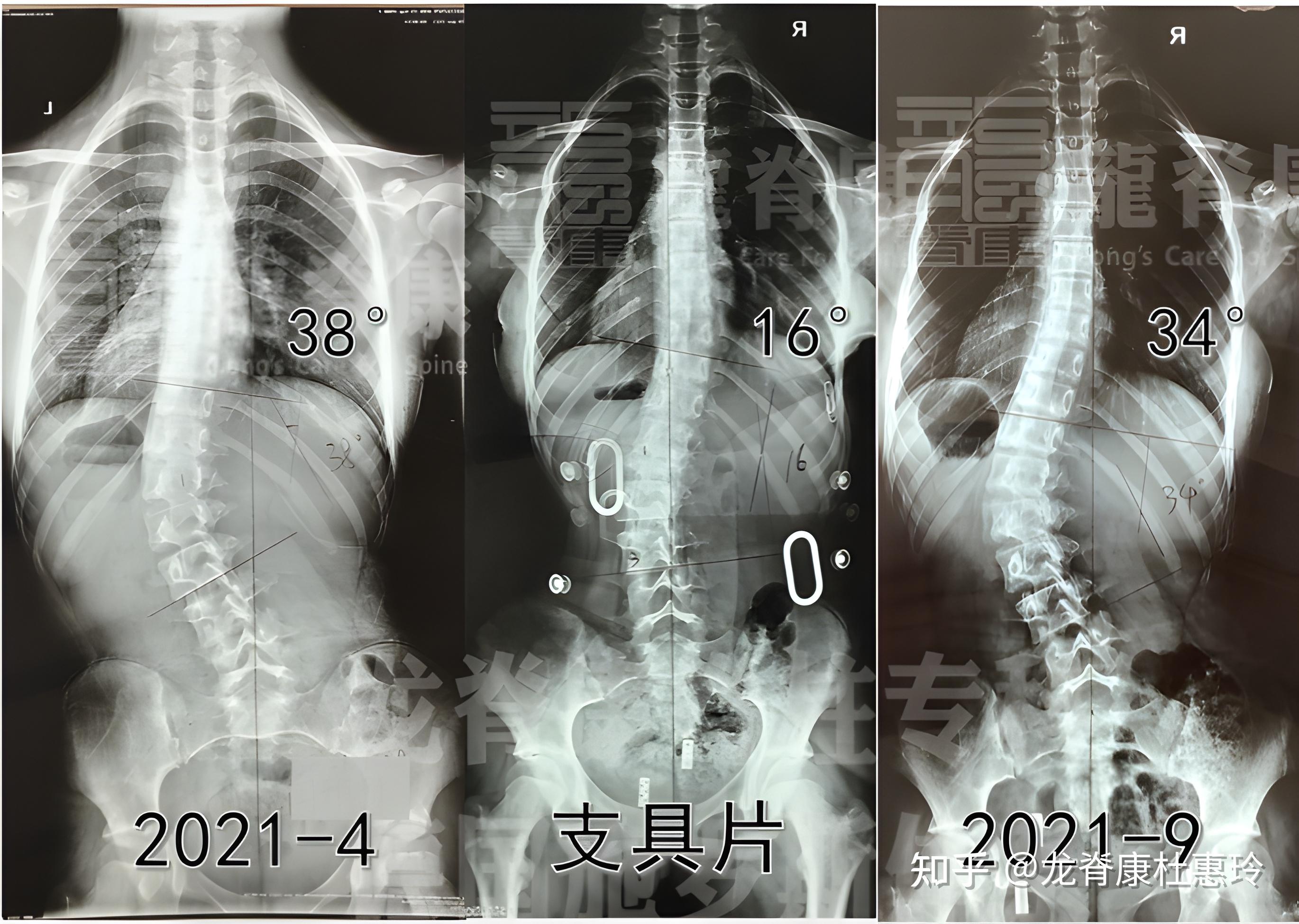 脊椎旋转比侧弯麻烦图片