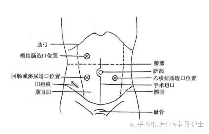 造口护理知识大全（新人必读） - 知乎