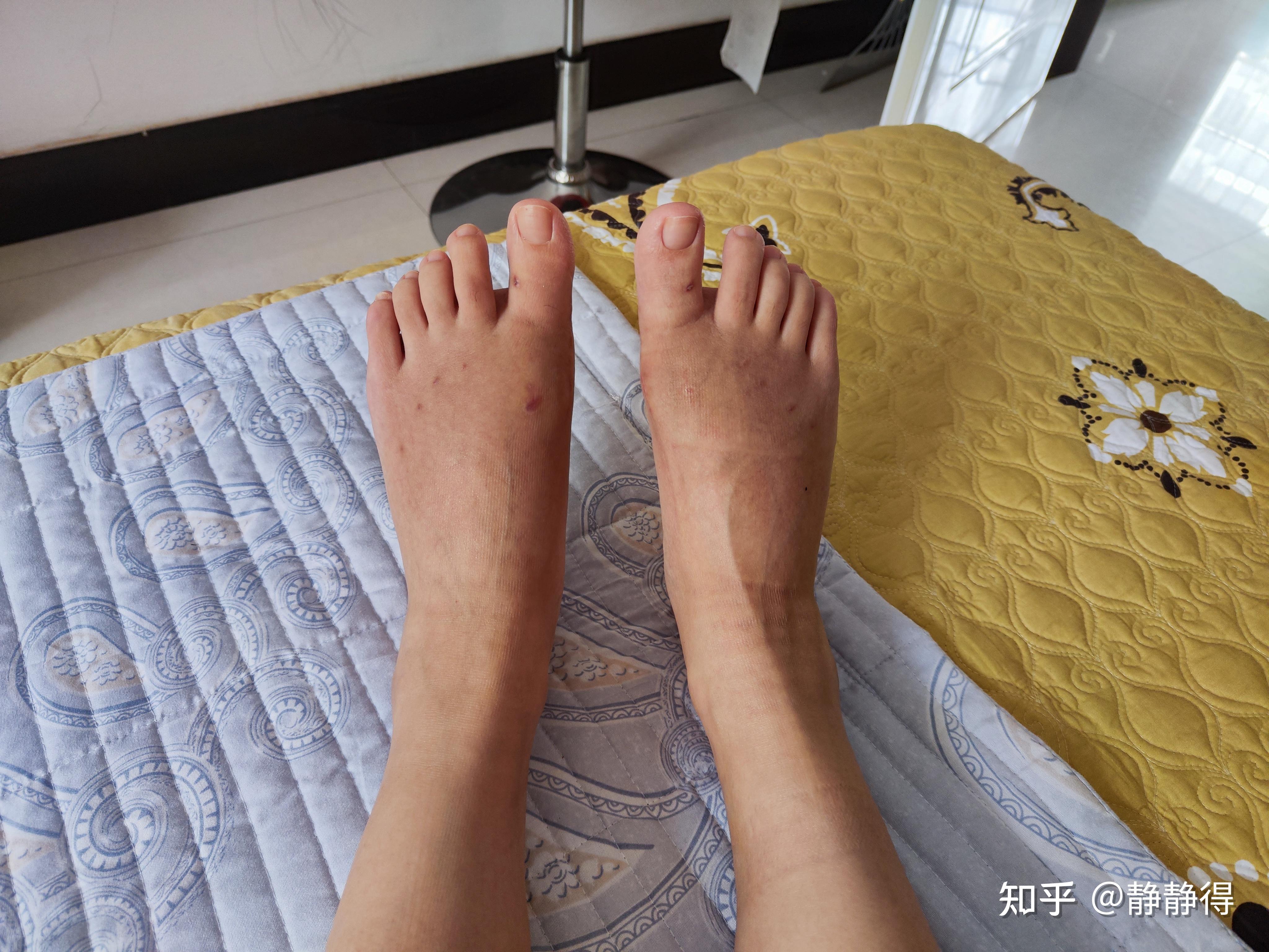 拇外翻术后恢复历程