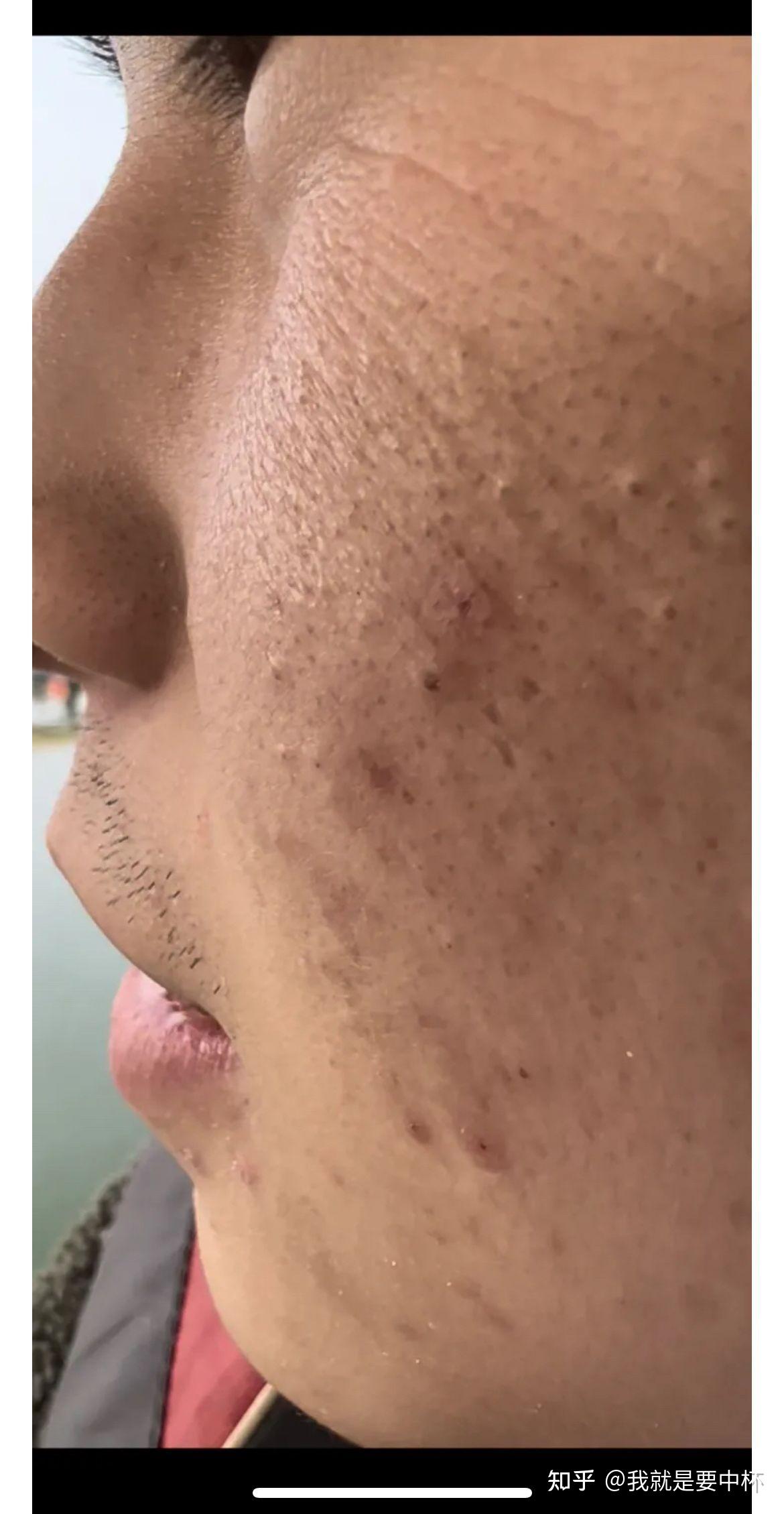 干皮脸部有泛红有闭口皮肤发黑发黄的可以进来看看