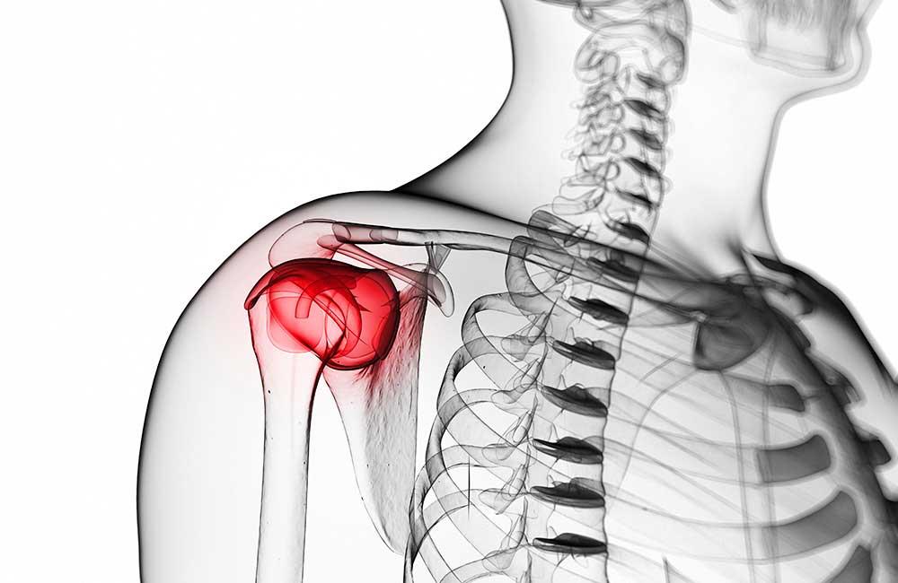 冻结肩的自助康复锻炼攻略