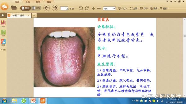 如何通过舌苔来判断身体健康与否?最全舌像来了,一分钟教你学会所有舌像! - 知乎