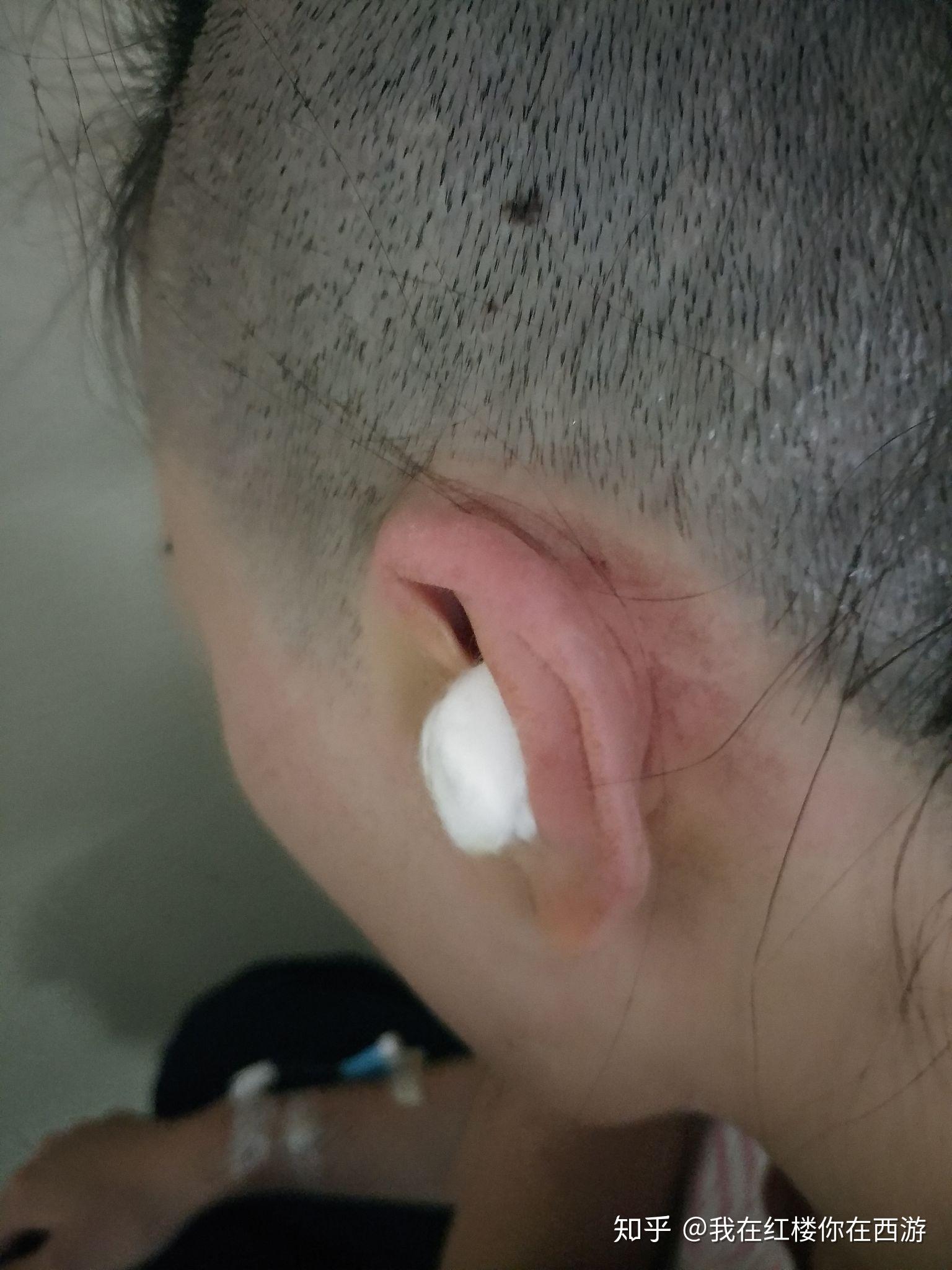 中耳炎引起鼓膜穿孔,做了鼓膜修补术 