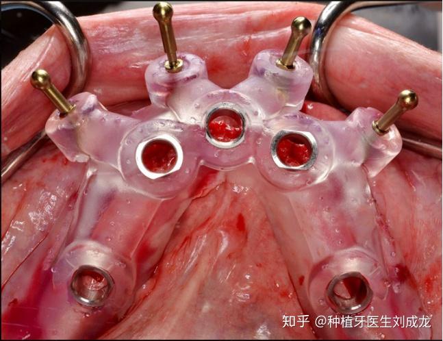 郑州瑞士iti种植牙种植导板下无牙颌种植修复恢复全口牙