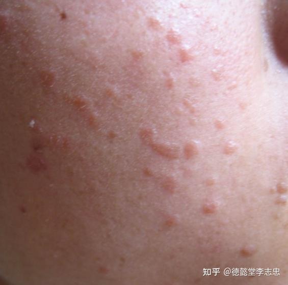 中医如何治疗扁平疣 疏通经络,抑菌杀菌,清除病毒 - 知乎