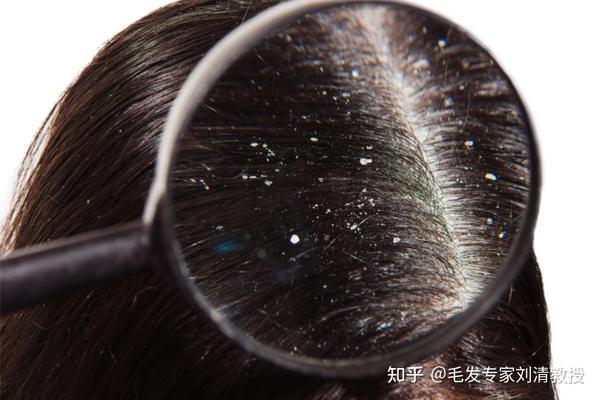 头皮屑到底该怎么办? - 知乎