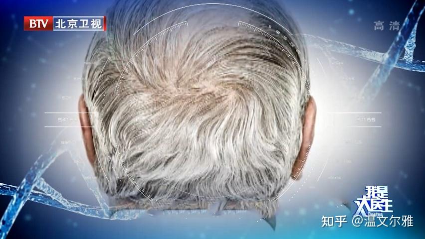“一夜白头”真的存在吗?白发增多到底和什么有关?两招调理法,帮你延缓白发的生长~ - 知乎
