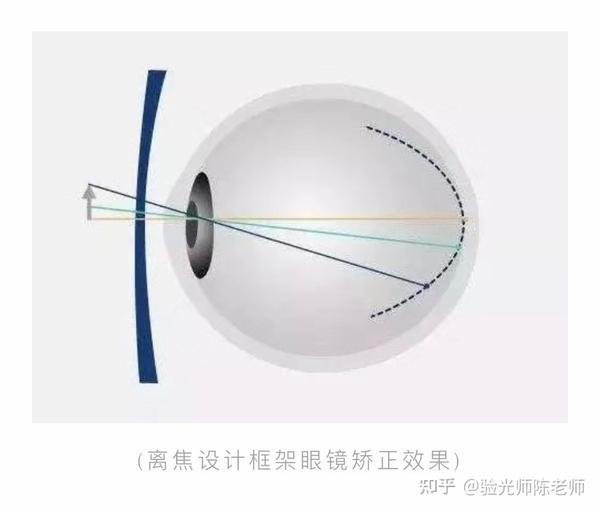 “离焦眼镜”为什么能延缓近视的发展? - 知乎