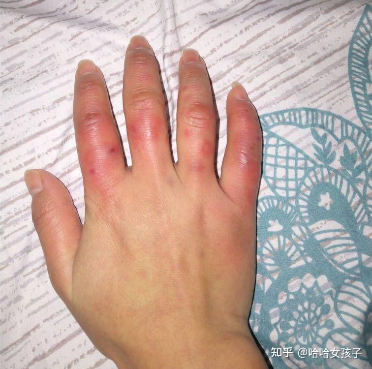 超级好用的冻疮膏推荐,一步到位,亲测有效 - 知乎