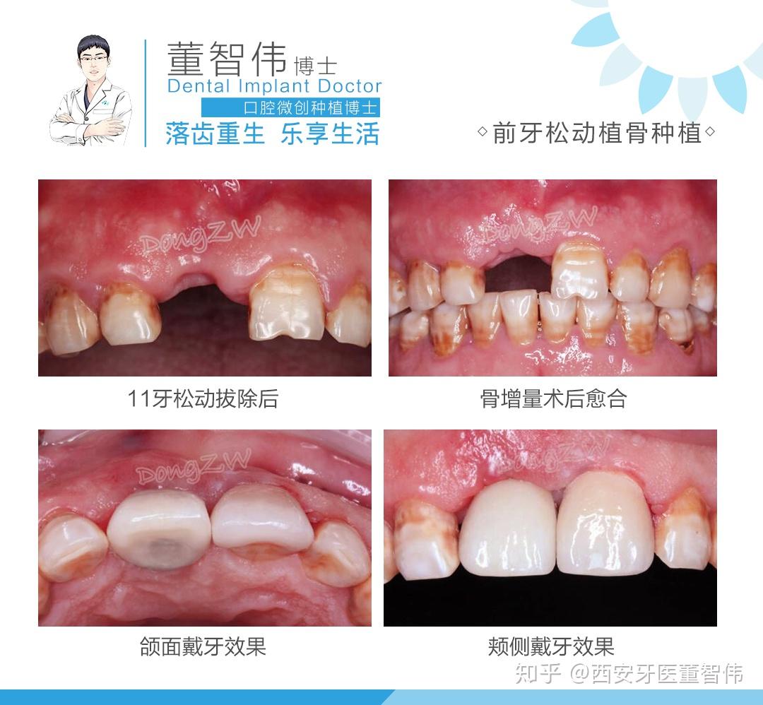 【前门牙松动复杂onlay植骨种植牙】案例