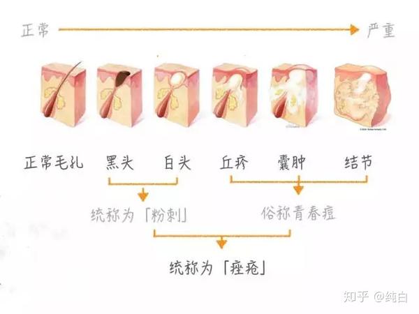 反复长痘的5个原因 - 知乎