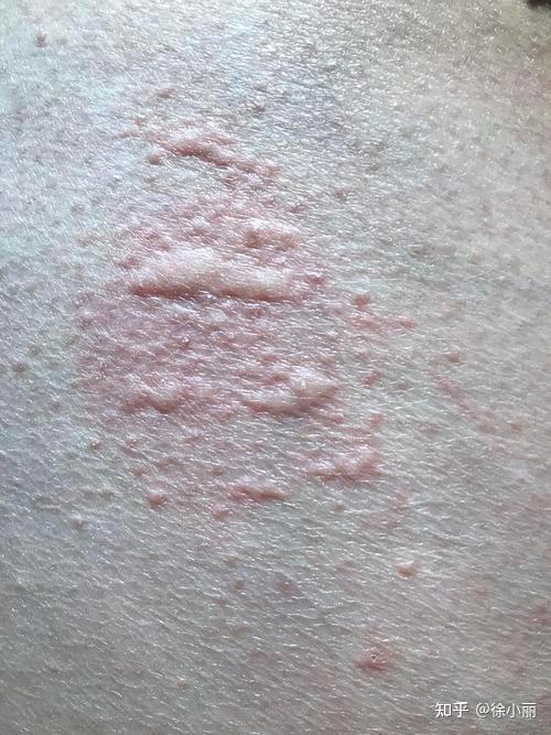 中医名家治疗荨麻疹的经验方 - 知乎