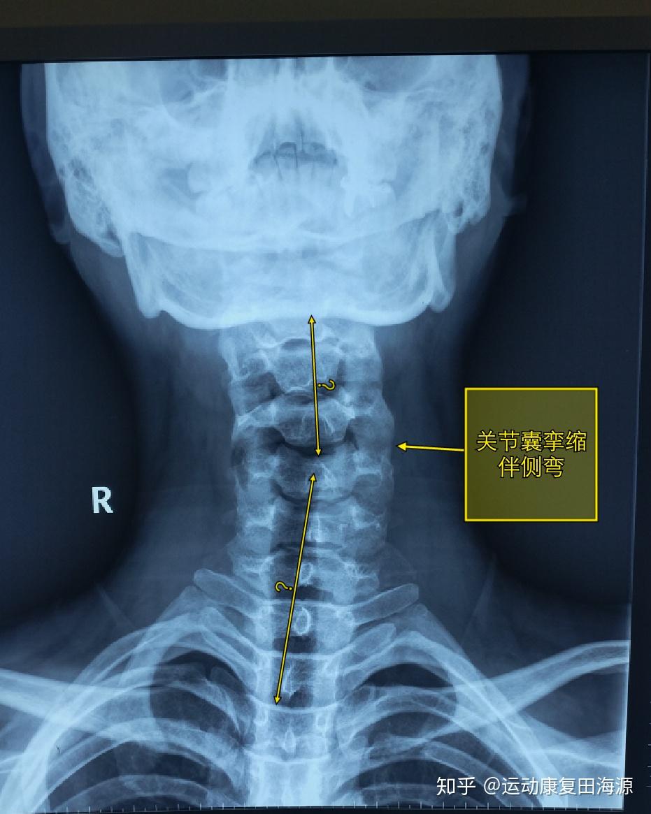 小儿寰枢椎半脱位图片图片