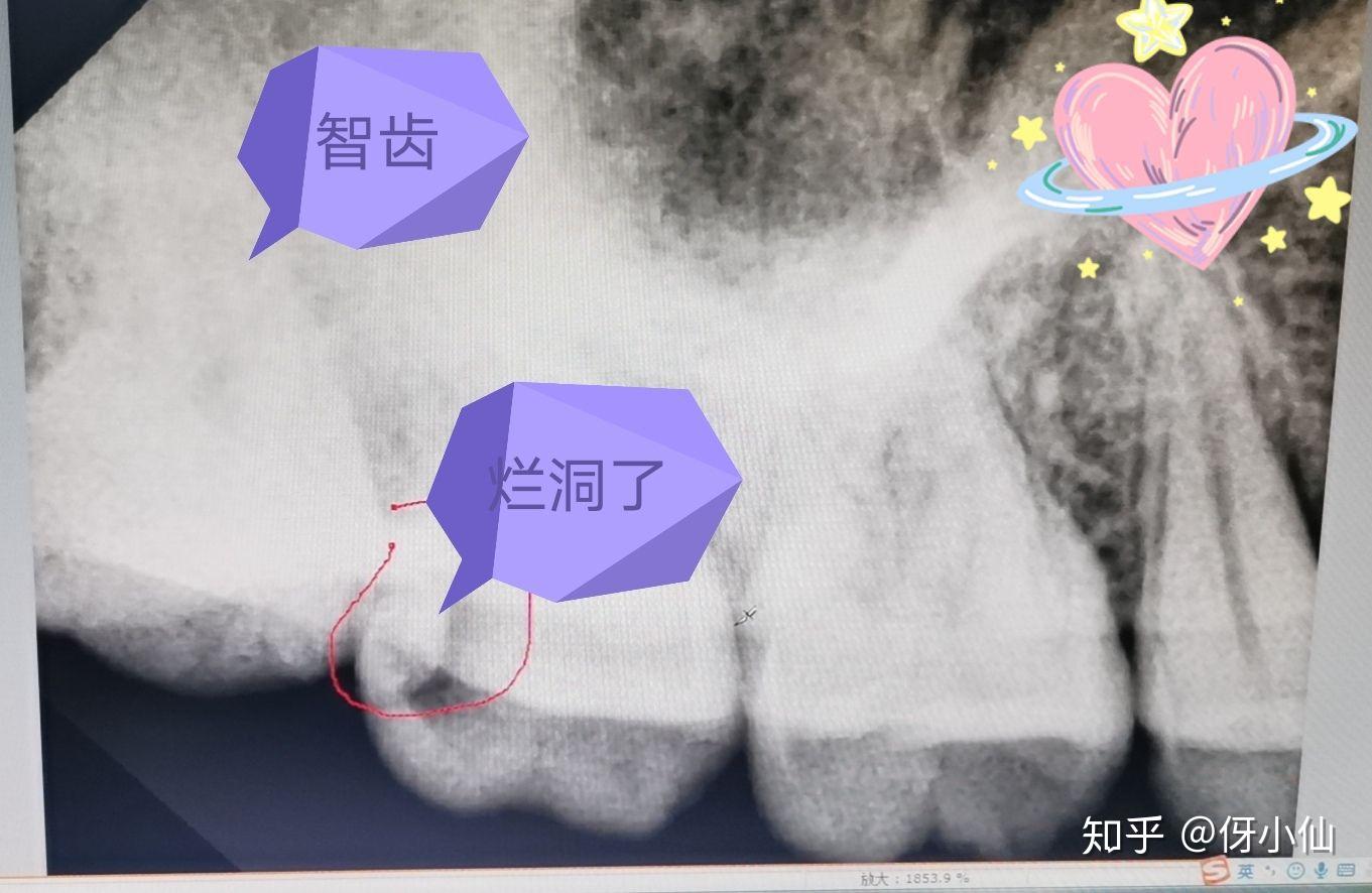 或者智齒靠後刷牙不容易刷到,智齒容易爛洞,所以