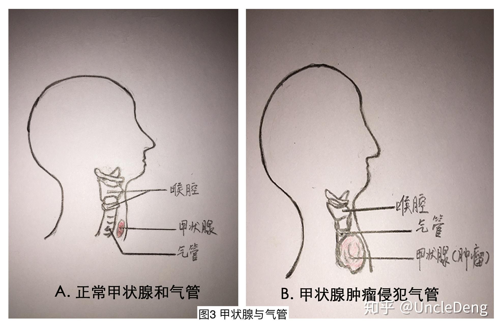 甲状腺癌侵犯气管1例