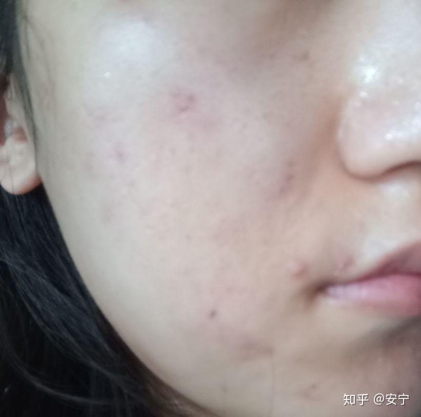 怎么才能不长痘痘和粉刺 v2-919bae20546bbcc74a89ce9f701e8e6f_r.jpg