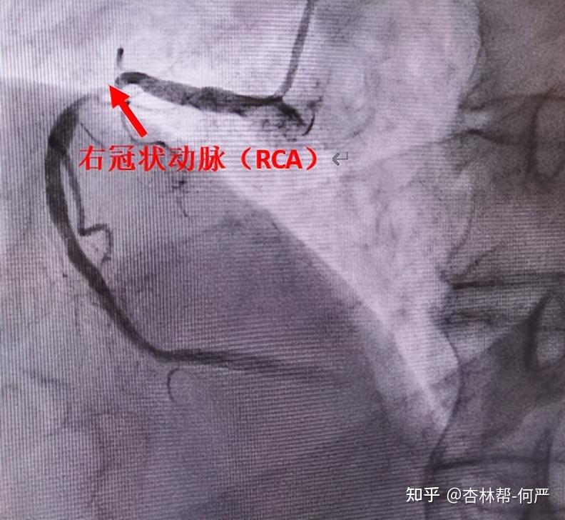 疫情下的心肌梗死救治六院心故事