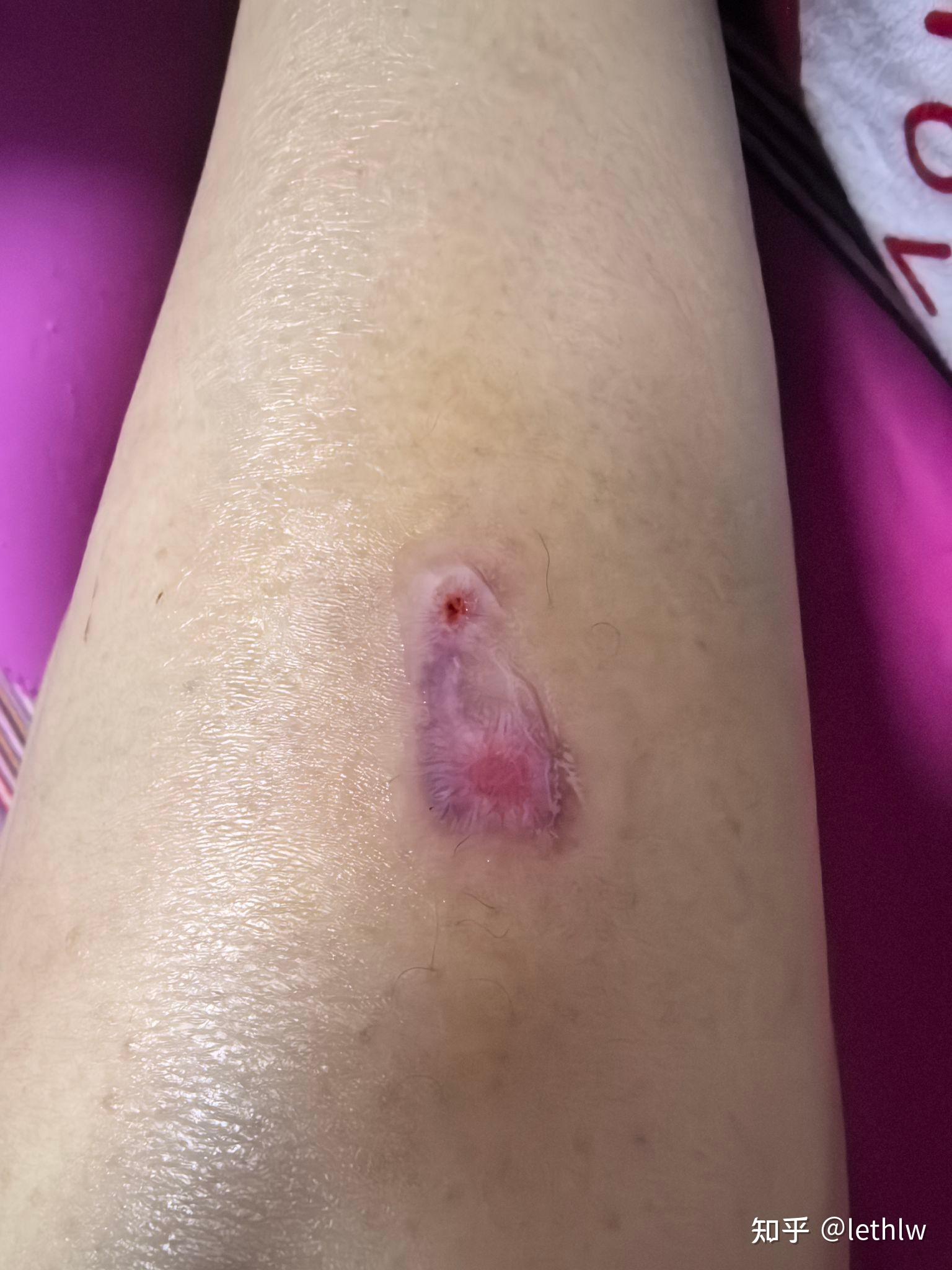 我的3度全层低温烫伤图片,2个半月了还没好