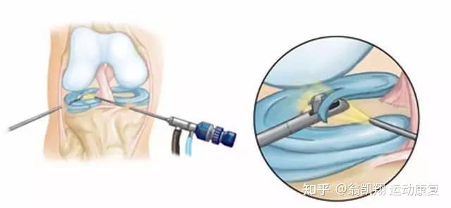 半月板前角后角體部的損傷恢復進度有何區別