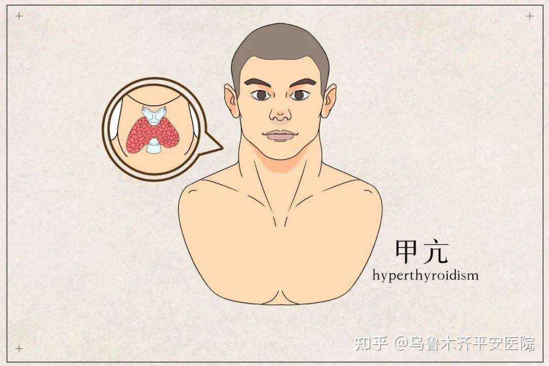 注意:这个类型的甲亢会以两种极端的方式出现 - 知乎