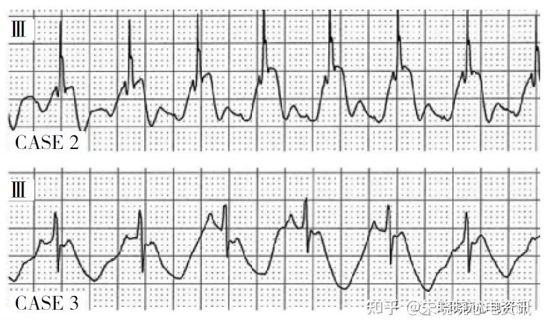 尖顶军盔征心电图改变