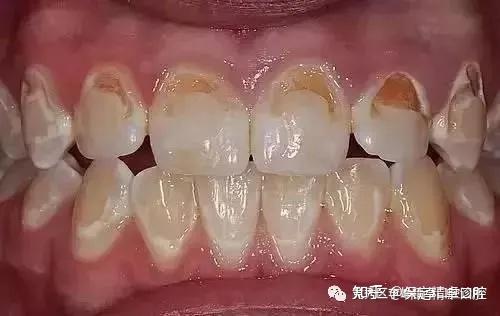 牙齿脱矿也叫脱钙,指人的牙齿牙釉质表面的钙磷脱落,因而使牙齿色泽