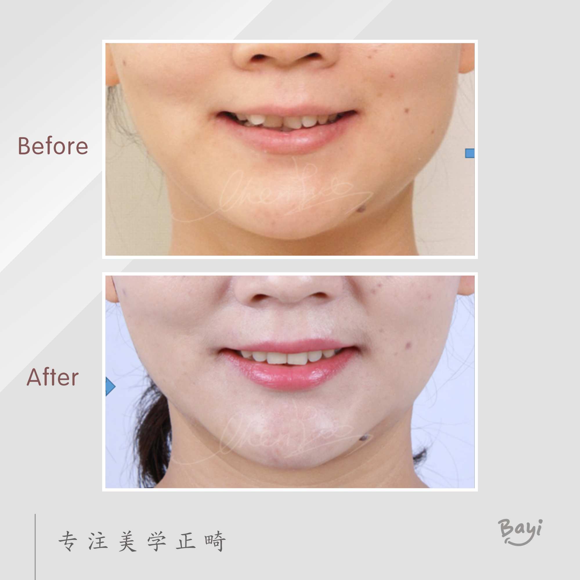 重庆牙齿矫正隐适美推磨牙向后解除牙列拥挤