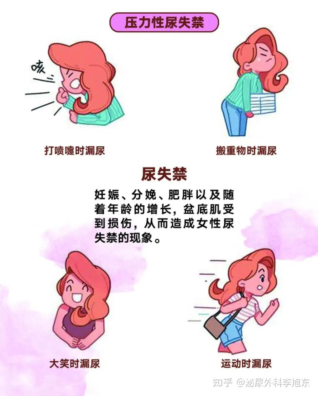 女性漏尿最佳治疗方法图片