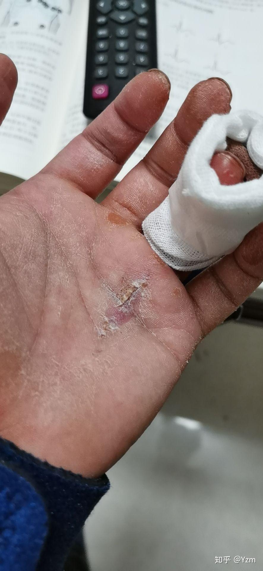 无名指屈肌肌腱断裂术后经历二次断裂生活的绝望从来都让人措手不及