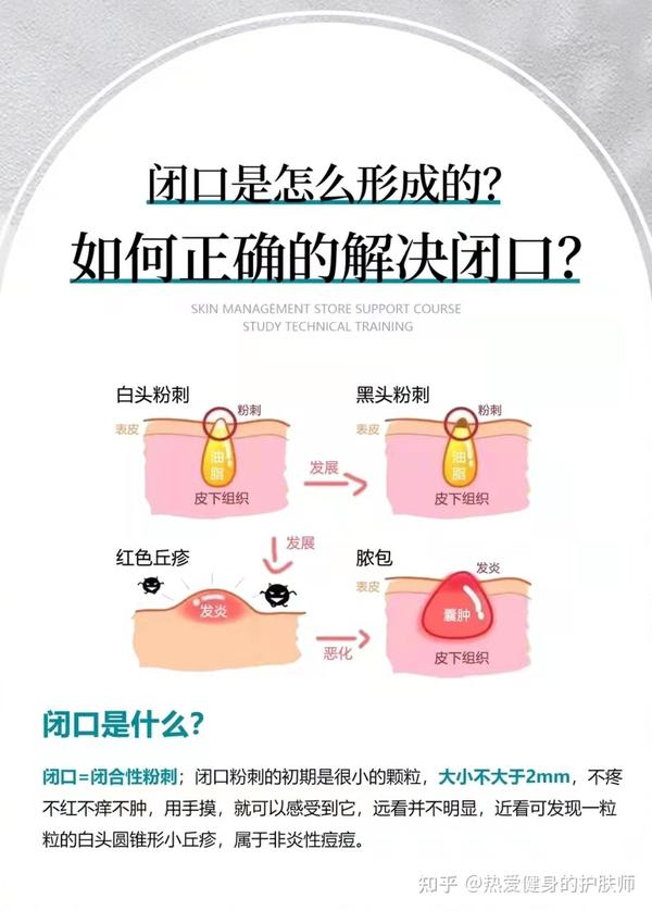 3分钟教你正确解决闭口 - 知乎
