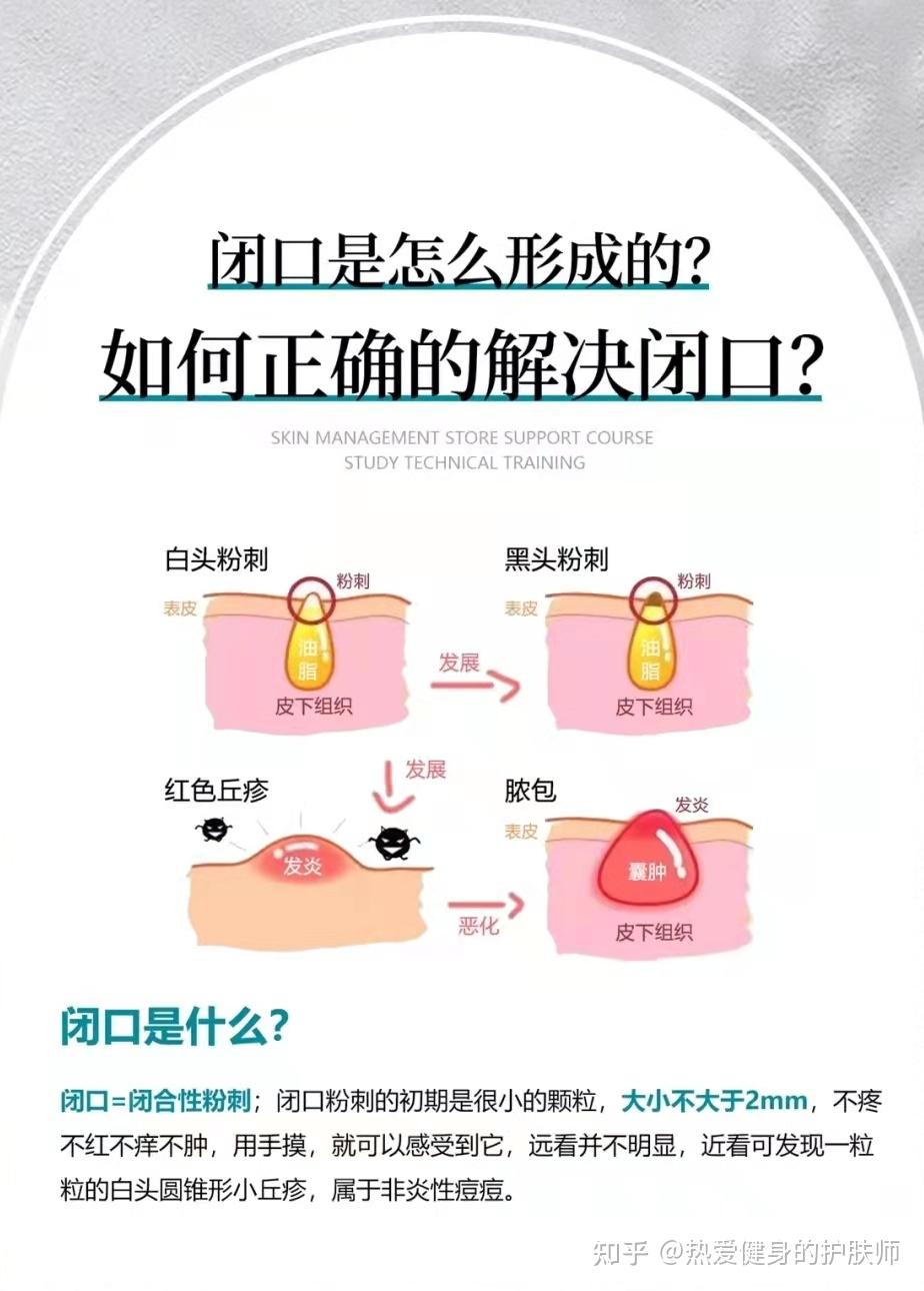 3分钟教你正确解决闭口 - 知乎