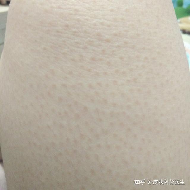 鸡皮肤挂皮肤科(鸡皮肤挂号皮肤科还是皮肤美容) 鸡皮肤挂皮肤科(鸡皮肤挂号皮肤科还是皮肤美容)