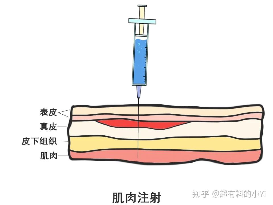 1 肌肉/肌内注射注射部位为上臂三角肌