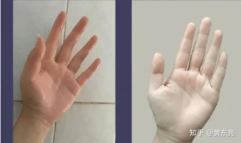 双手不自觉就湿了?当青春年华遇上烦恼手汗 - 知乎