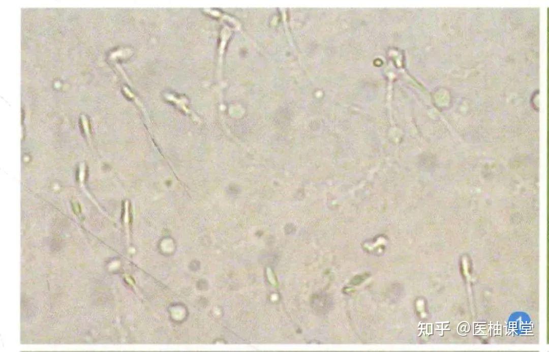 尿液中其他有形成分图片汇总，建议收藏！ 知乎