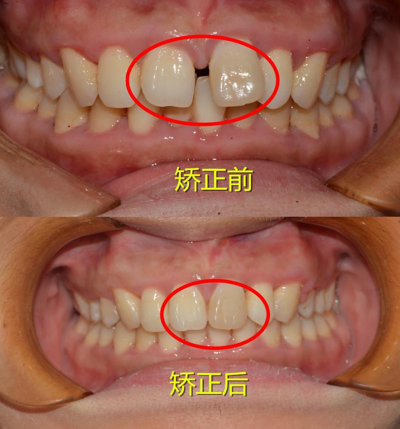 用时11个月时间完成矫正,门牙牙缝关闭,牙齿变得整齐.